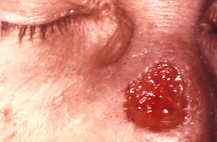 圖 3，由三期梅毒引起的一種潰瘍性病變，位於鼻子。