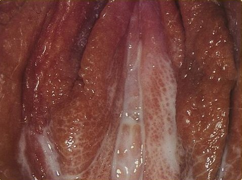 圖 2，淋病導致的女性陰部出現排洩物，在該圖片裡，這些排洩物分佈在外生殖器上。