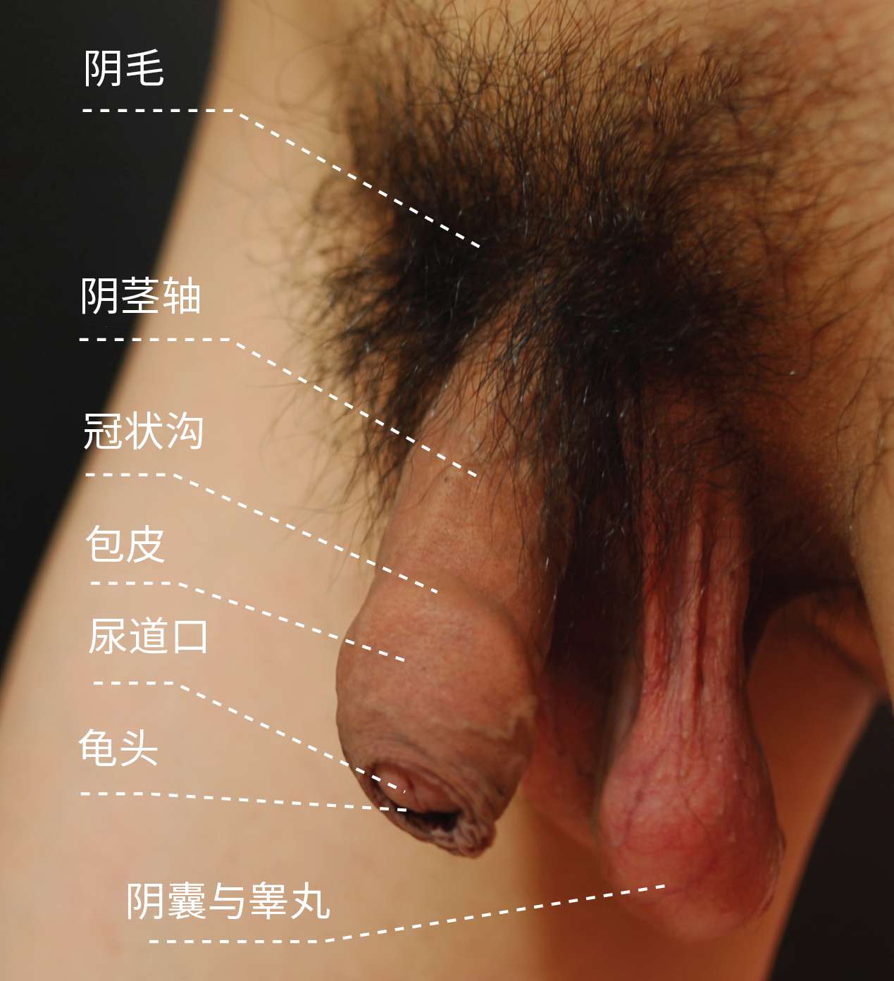 图 9， 亚洲男性外生殖器（疲软状态，包皮覆盖）