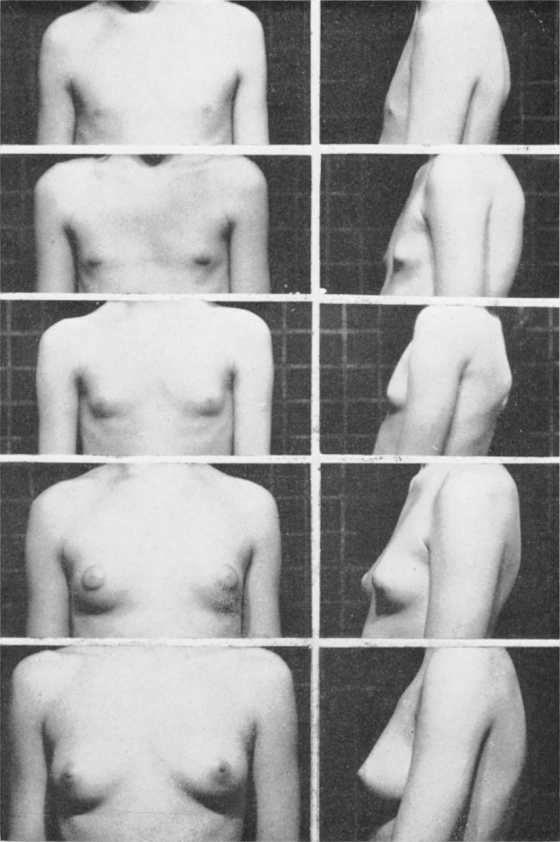 图5，乳房发育的五个阶段，如上文描述。
