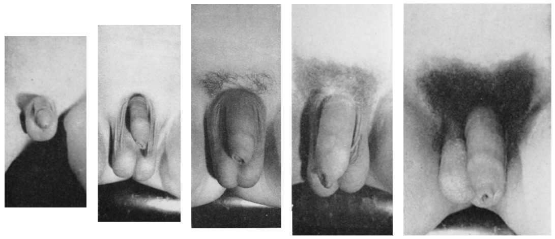 图6，男性外阴发育的五个阶段，如上文描述。