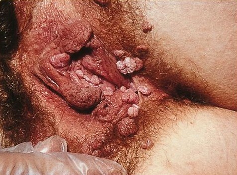 图 2，女阴部位出现的尖锐湿疣，在该图片里，在女性阴部分布着菜花样的疣。