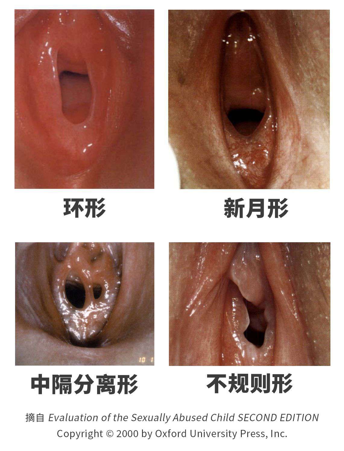 图 6，处女膜的其中四种形态