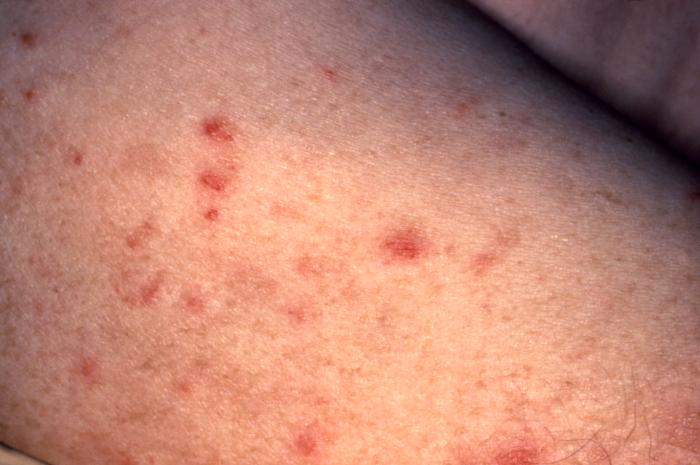 图 2，二期梅毒，梅毒在全身扩散导致的大腿皮疹